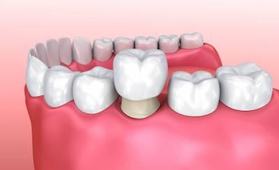 Dental Crowns and Bridges Serene Dentistry of North Salt Lake Dentist in Salt Lake City Ut. Dr. Will Bates