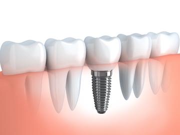 Dental implants in gums