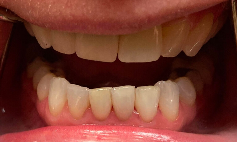 Smile Gallery - Internal Bleaching Serene Dentistry of North Salt Lake Dentist in Salt Lake City Ut. Dr. Will Bates