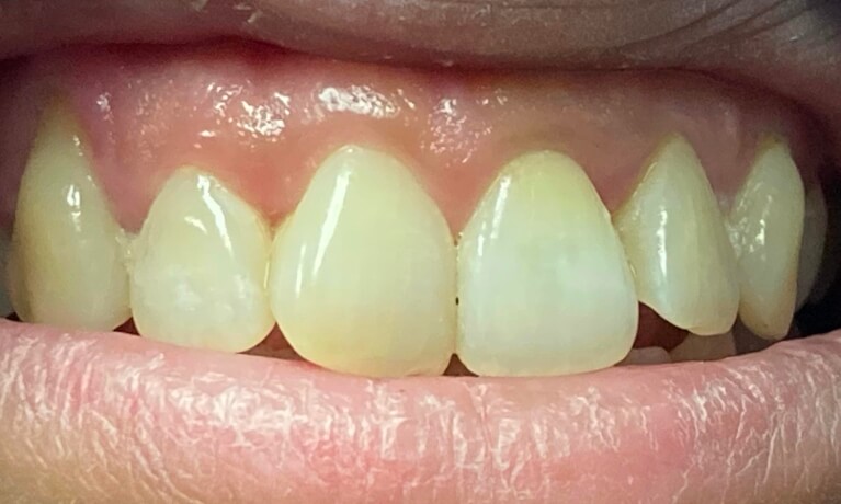 Smile Gallery - Internal Bleaching Serene Dentistry of North Salt Lake Dentist in Salt Lake City Ut. Dr. Will Bates