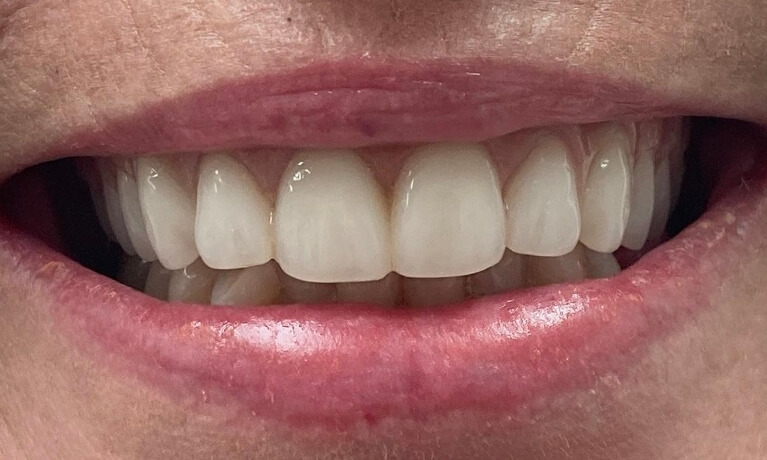 Smile Gallery - Arch Rehab Serene Dentistry of North Salt Lake Dentist in Salt Lake City Ut. Dr. Will Bates