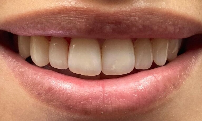 Smile Gallery - Porcelain Vaneers Serene Dentistry of North Salt Lake Dentist in Salt Lake City Ut. Dr. Will Bates