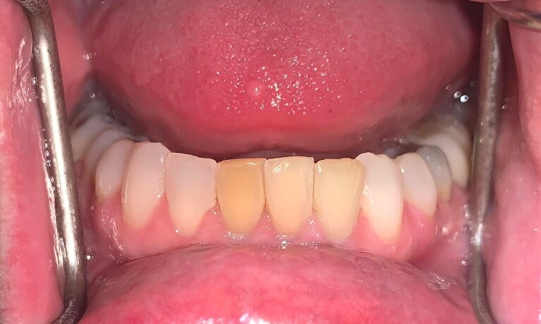 Smile Gallery - Internal Bleaching Serene Dentistry of North Salt Lake Dentist in Salt Lake City Ut. Dr. Will Bates