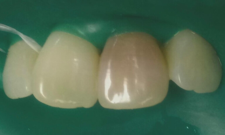 Smile Gallery - Internal Bleaching Serene Dentistry of North Salt Lake Dentist in Salt Lake City Ut. Dr. Will Bates