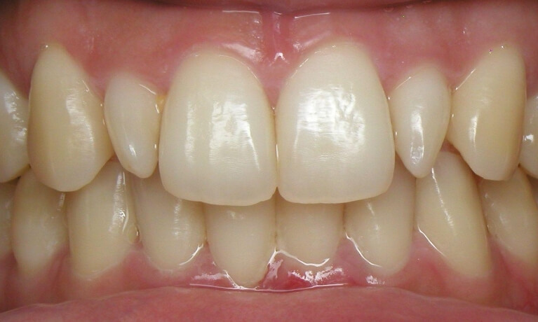 Smile Gallery - Porcelain Vaneers Serene Dentistry of North Salt Lake Dentist in Salt Lake City Ut. Dr. Will Bates