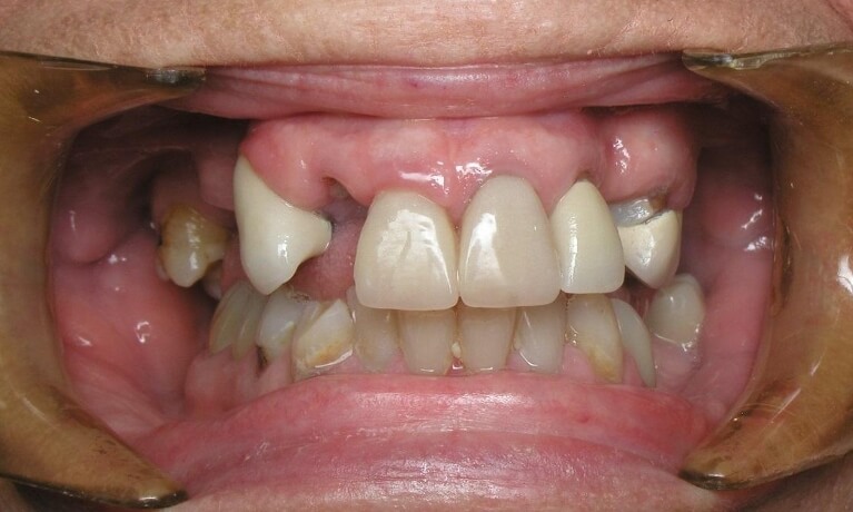 Smile Gallery - Arch Rehab Serene Dentistry of North Salt Lake Dentist in Salt Lake City Ut. Dr. Will Bates