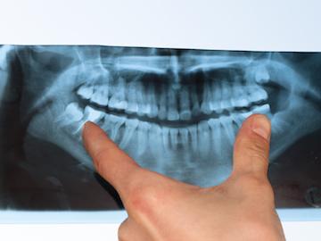 TMJ & Bruxism Treatment pano xray