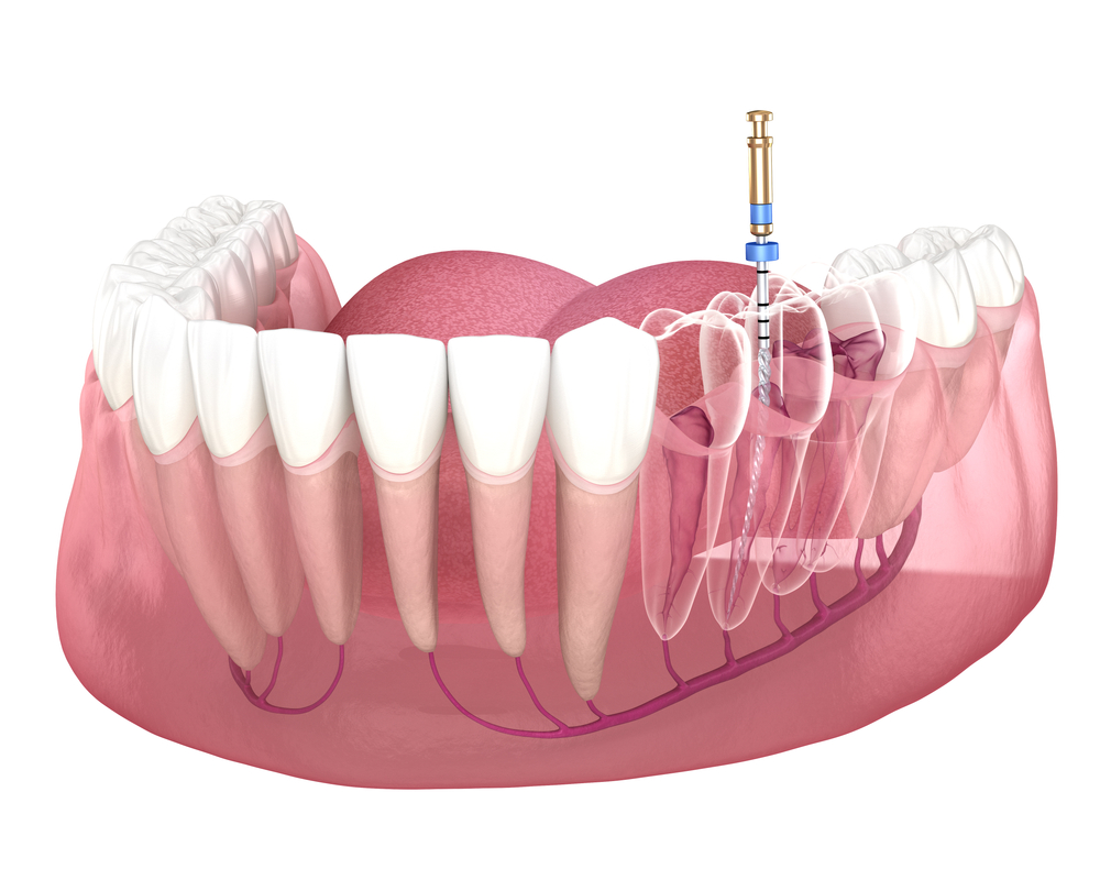 root canal north salt lake Serene Dentistry of North Salt Lake. General, Cosmetic, Restorative, Pediatric Family Dentistry Dentist in Salt Lake City UT 84054